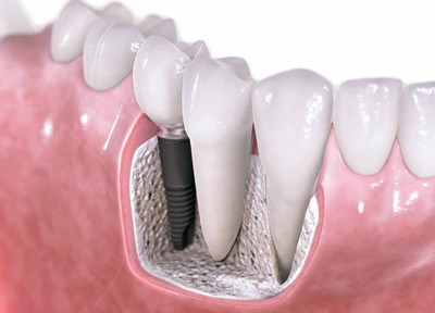 Отзывы об имплантации зубов — Стоматология «Все свои!» — официальный сайт